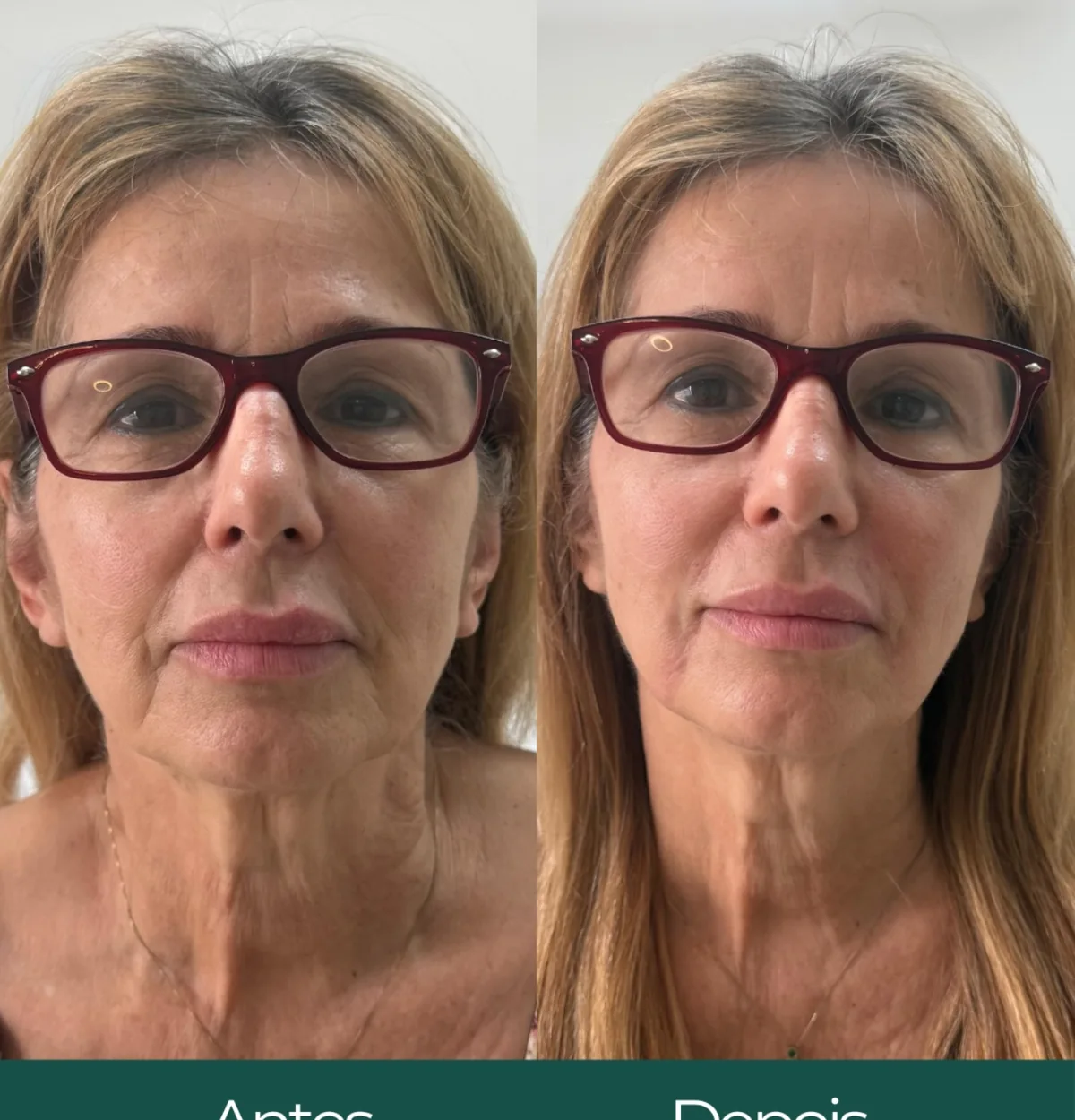 Antes e depois de harmonização facial em paciente 50+.