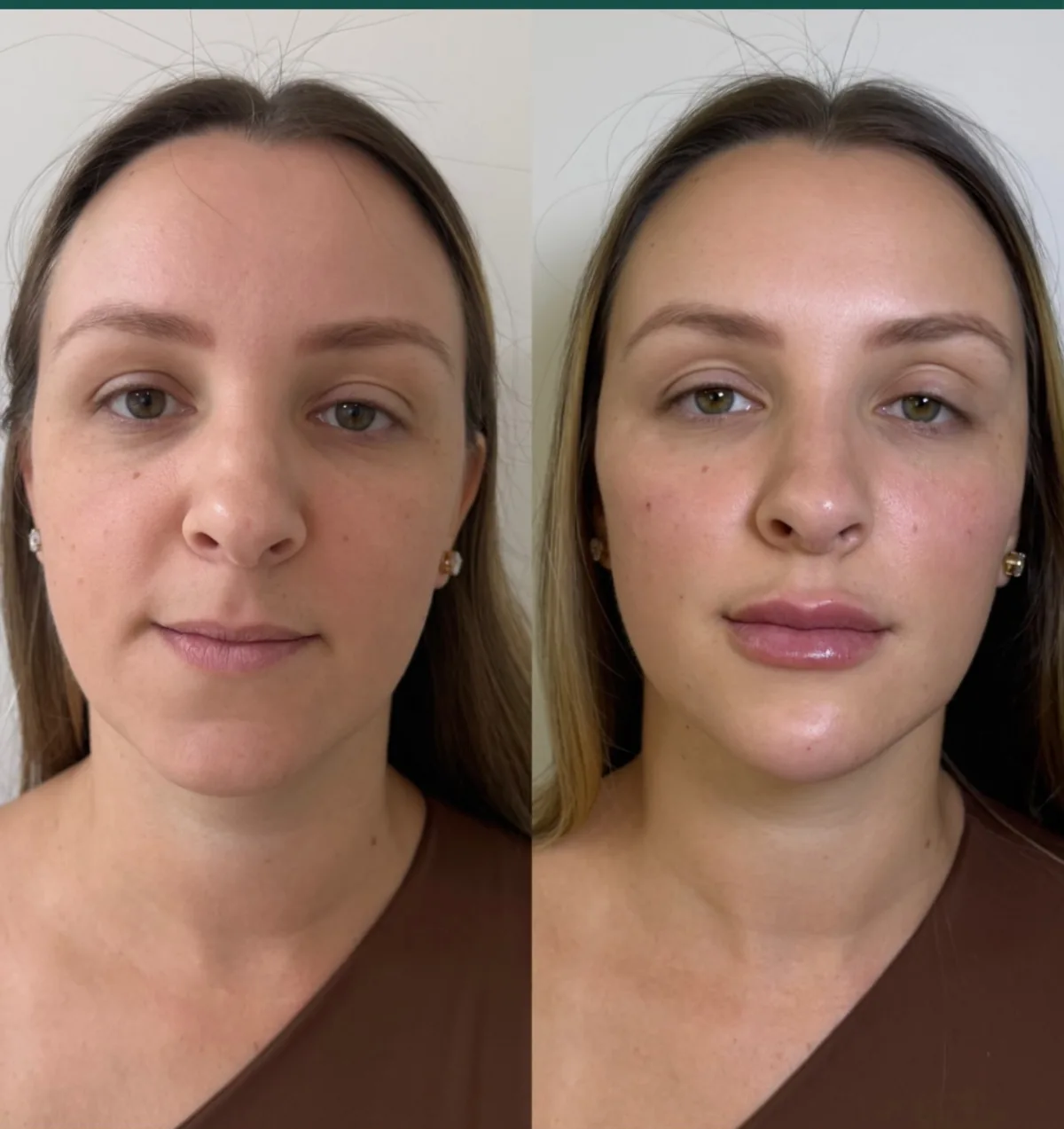 Antes e depois de harmonização facial, vista frontal.