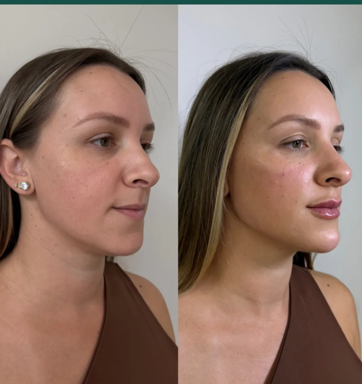 Antes e depois de contorno de perfil, vista de três quartos.