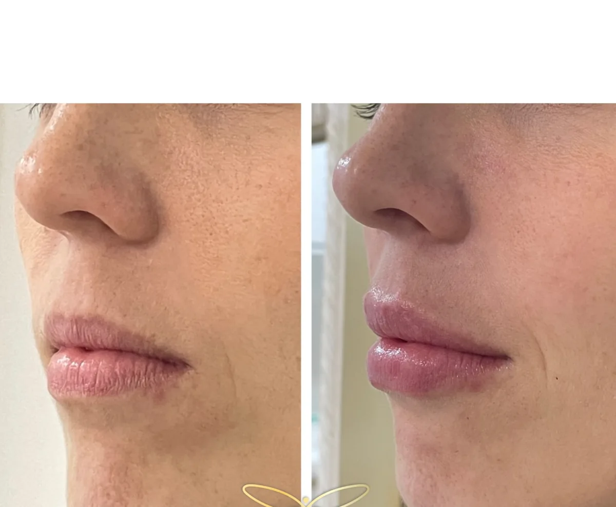 Antes e depois de preenchimento labial, vista lateral.