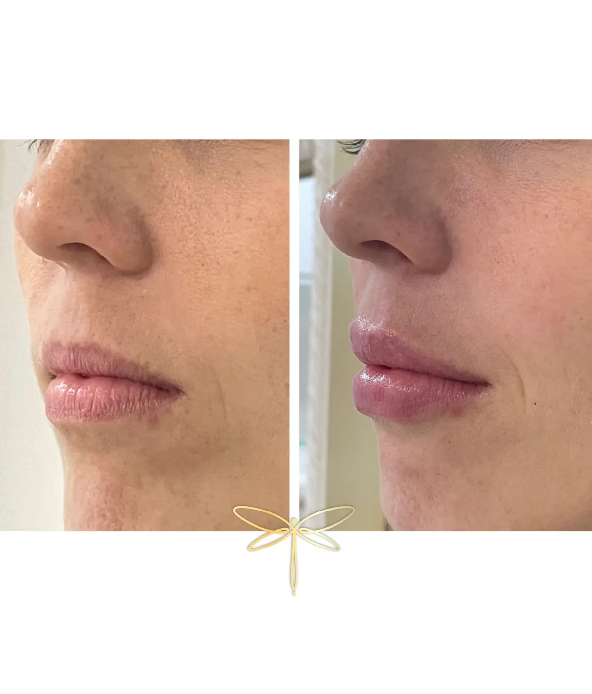 Antes e depois de preenchimento labial, vista de três quartos.